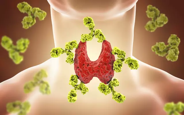 The Connection Between Hashimoto's Disease and Thyroid Cancer